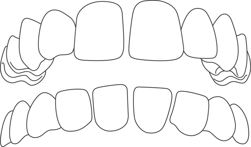 Teeth with Spacing Issues