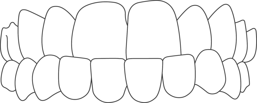 Underbite Teeth
