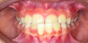 patient's teeth showing crossbite in anterior 
