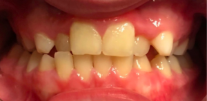 patient's teeth showing crossbite in anterior and posterior