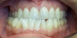 photo of ortho patient's smile before orthognathic surgery