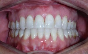 photo of ortho patient's smile after orthognathic surgery