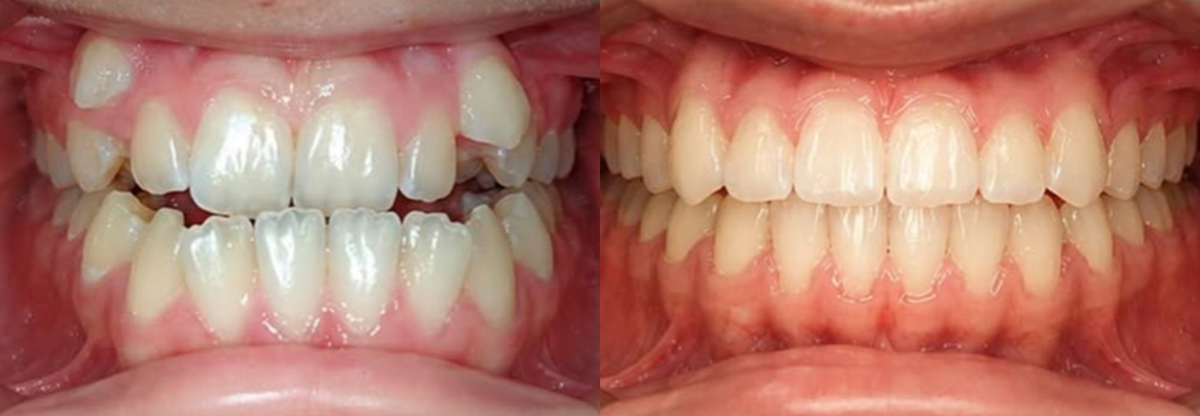 Before and after smile transformation with braces and clear aligners at Premiere Orthodontics in Orlando.