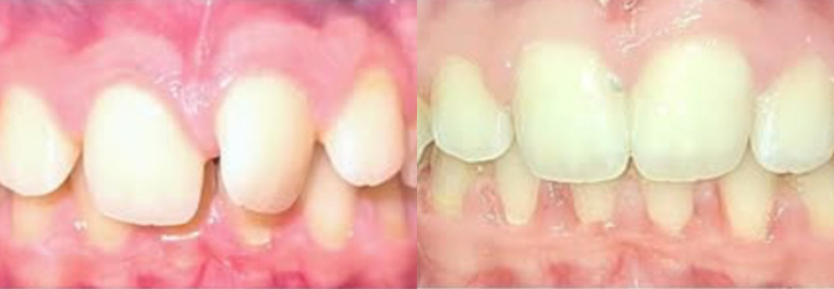 Before and after smile transformation with braces and clear aligners at Premiere Orthodontics in Orlando,